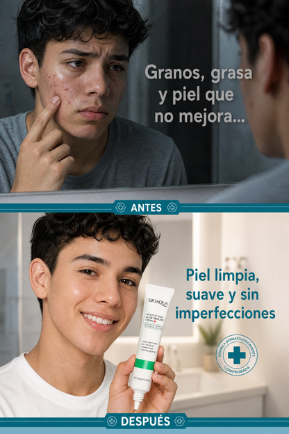 Crema Antiacné Bioaqua - Antes y Después